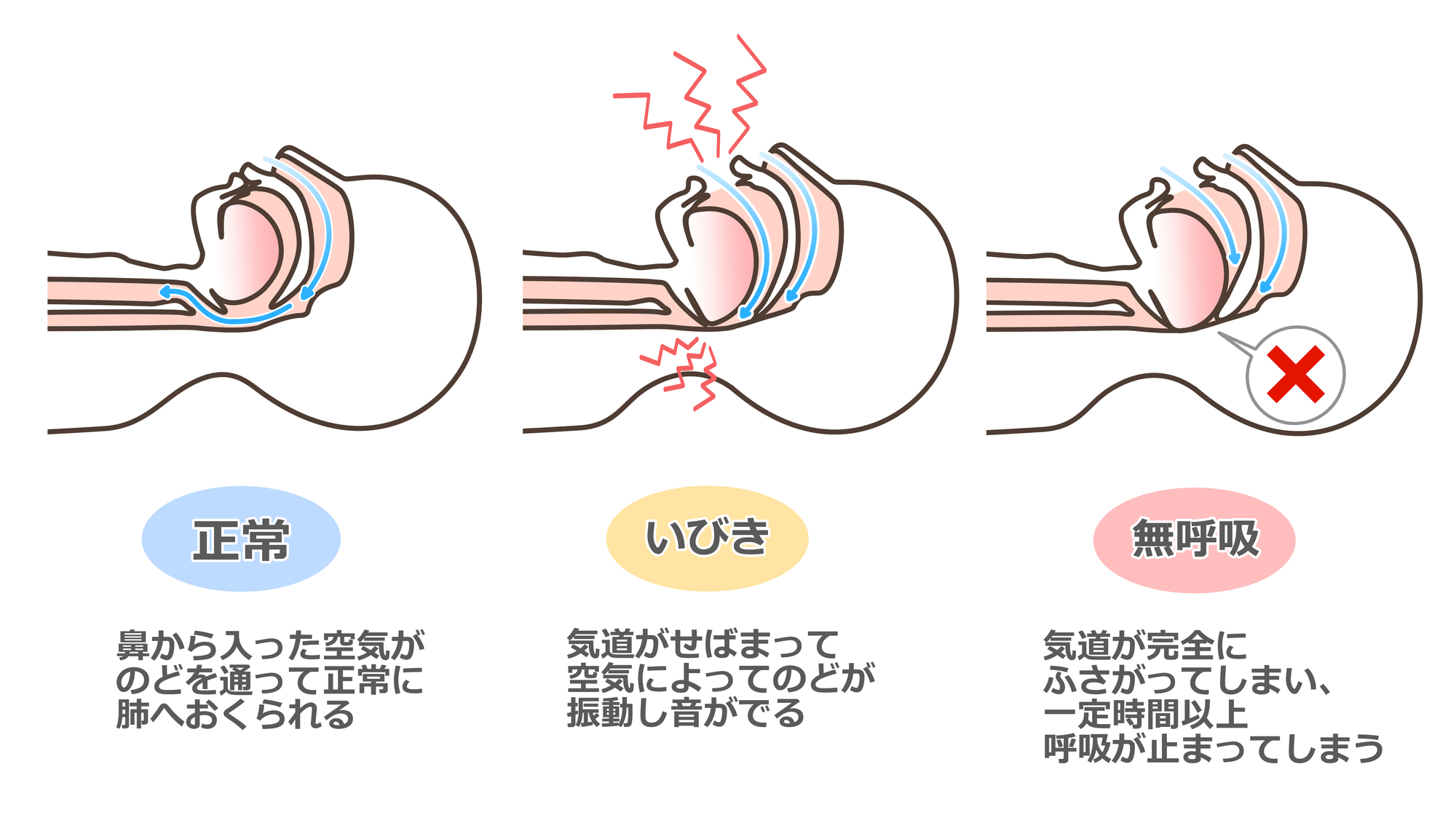 金剛（大阪狭山市）の歯医者、医療法人西村歯科 金剛本院・駅前診療所の睡眠時無呼吸症候群